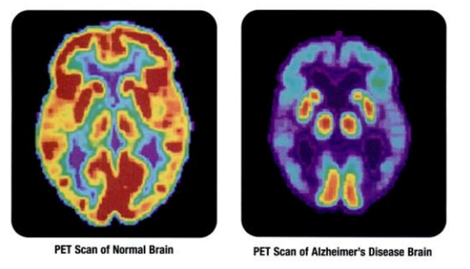 Porovnanie zdravého mozgu a mozgu s Alzheimerom